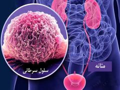 هشدار درباره یکی از شایع‌ترین سرطان‌های مردان