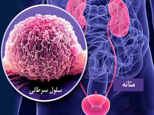 هشدار درباره یکی از شایع‌ترین سرطان‌های مردان